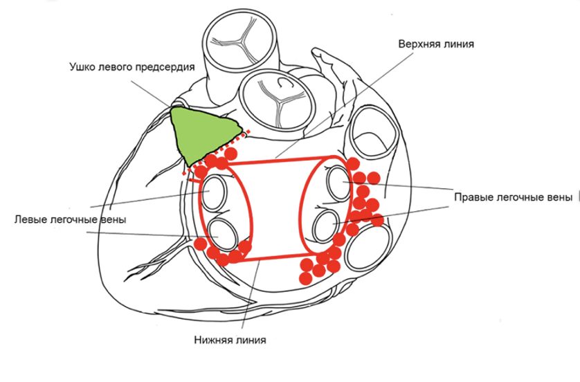 Схема аблации
